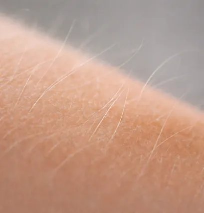 Визуализация процедуры перманентного удаления волос